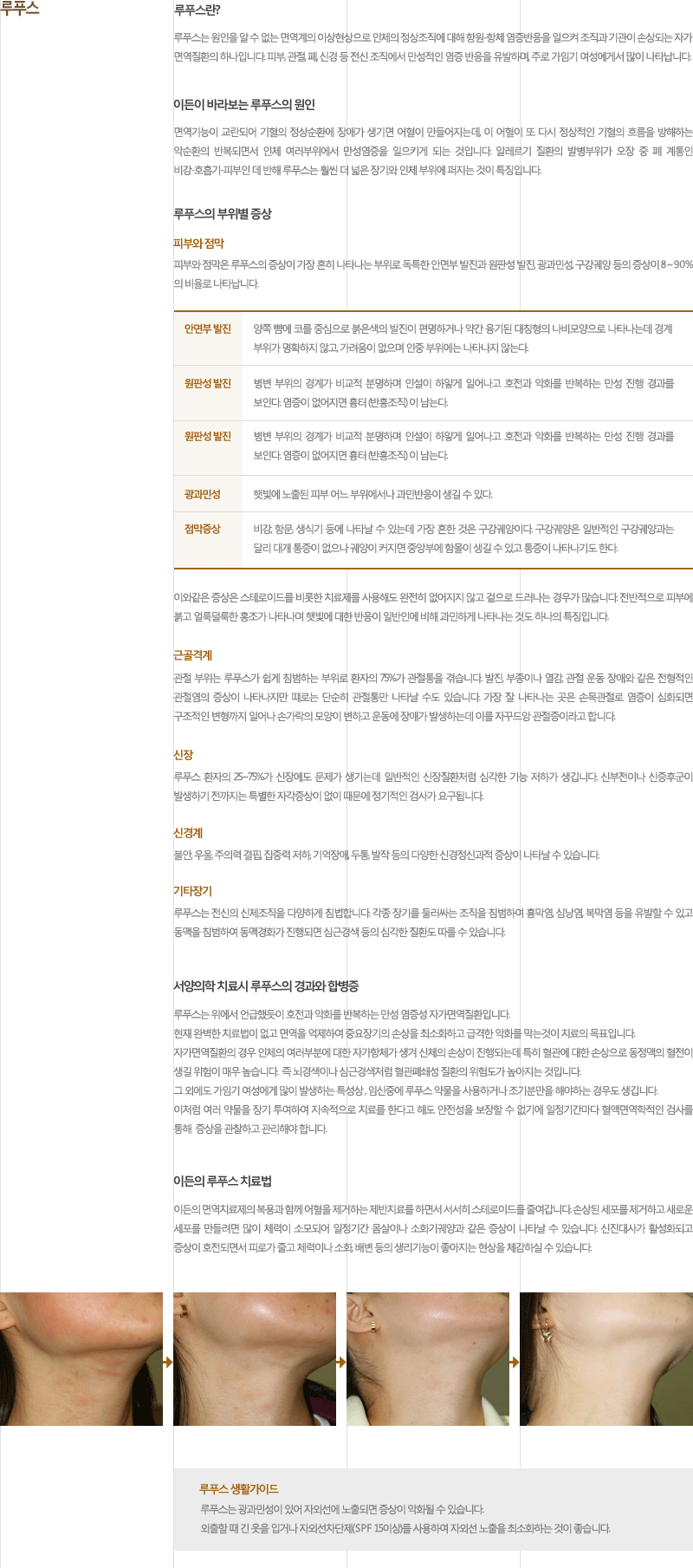 루프스